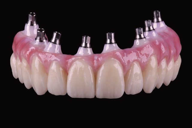 Full-Arch Implant 케이스 01