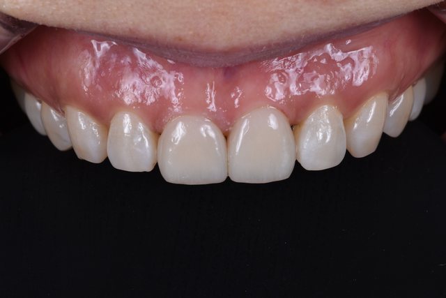 Smile Design 케이스 13